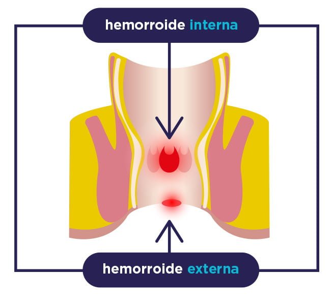 Gráfico hemorroides