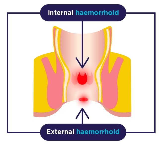 internal-External